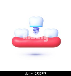 Tooth implant 3d design concept on white background. Healthcare medicine concept. Vector illustration design Stock Vector