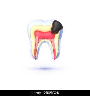 Tooth caries in 3d style. 3d vector isolated icon. Vector illustration Stock Vector