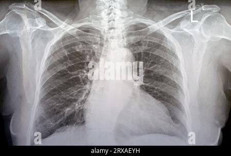 Plain x ray chest of an old woman with almost normal study of bones, lungs and heart, normal chest cavity, ribs and wall, no signs of white patches or Stock Photo