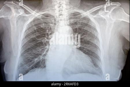 Plain x ray chest of an old woman with almost normal study of bones, lungs and heart, normal chest cavity, ribs and wall, no signs of white patches or Stock Photo