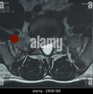 Magnetic resonance image of the lumbar spine Stock Photo - Alamy