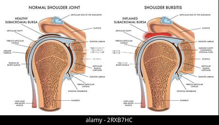 Medical illustration comparing a normal shoulder to a shoulder bursitis, with annotations. Stock Vector
