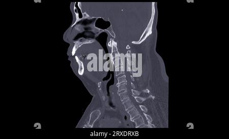 CT C-Spine or Cervical spine sagittal view in patient trauma