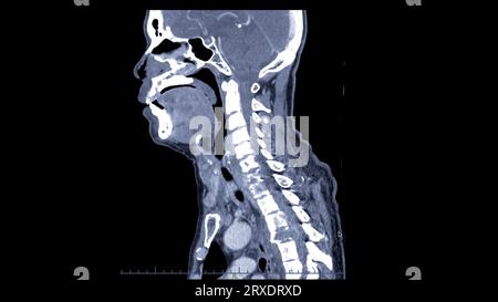 CT C-Spine or Cervical spine sagittal view Stock Photo - Alamy
