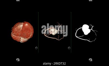 CT Cardiac 3D rendering or CTA coronary artery for prevention coronary ...