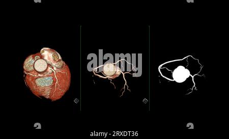 CT Cardiac 3D rendering or CTA coronary artery for prevention coronary ...