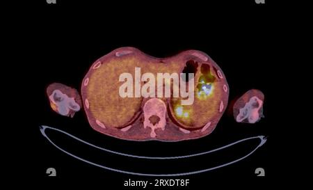 PET CT image of Whole human body  Axial ,coronal and sagittal plane. Positron Emission Computed Tomography . Stock Photo