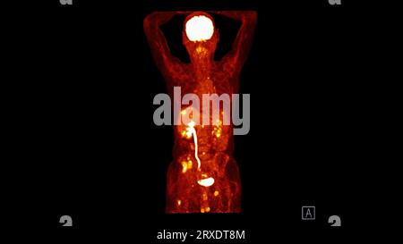 PET CT image of Whole human body  coronal plane. Positron Emission Computed Tomography . Stock Photo