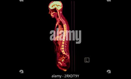 PET CT image of Whole human body   sagittal plane. Positron Emission Computed Tomography . Stock Photo