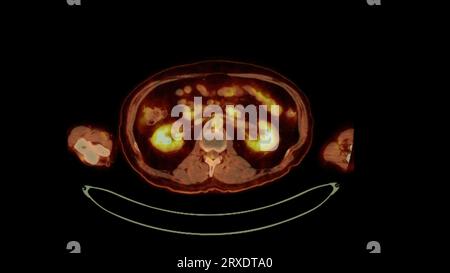 PET CT image of Whole human body  Axial  plane. Positron Emission Computed Tomography . Stock Photo