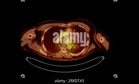 PET CT image of Whole human body  Axial  plane. Positron Emission Computed Tomography . Stock Photo