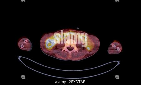 PET CT image of Whole human body  Axial  plane. Positron Emission Computed Tomography . Stock Photo