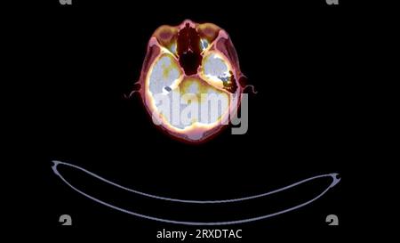 PET CT image of Whole human body  Axial  plane. Positron Emission Computed Tomography . Stock Photo