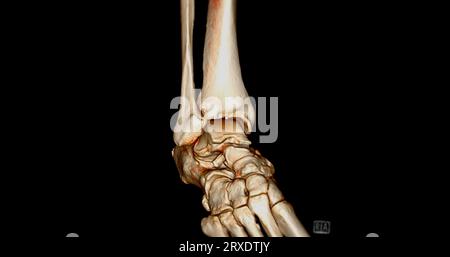 CT Scan ankle joint with 3d rendering of calcaneus bone showing ...