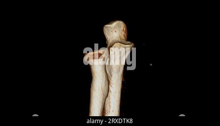 CT scan of elbow joint 3d rendering showing ulna and radius bone Stock ...