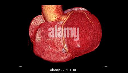 CT Cardiac 3D rendering  or CTA coronary artery for prevention coronary artery diseases. Stock Photo