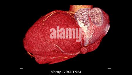 CT Cardiac 3D rendering  or CTA coronary artery for prevention coronary artery diseases. Stock Photo