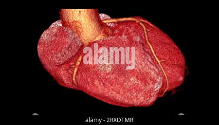 CT Cardiac 3D rendering  or CTA coronary artery for prevention coronary artery diseases. Stock Photo