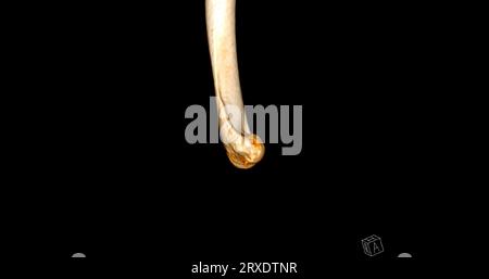 CT scan of elbow joint 3d rendering showing ulna and radius bone Stock ...