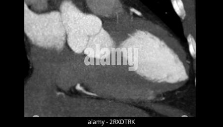 CT Cardiac   or CTA coronary artery vertical long axis view for prevention coronary artery diseases. Stock Photo