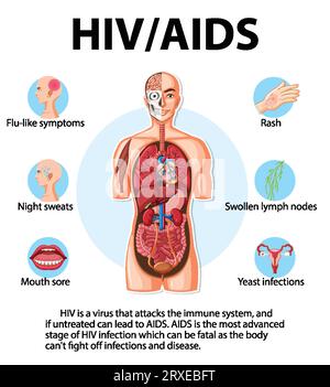 Illustration of how HIV/AIDS virus attacks the immune system Stock Vector