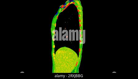 CT scan of Chest sagittal view in color mode  for diagnostic Pulmonary embolism (PE) , lung cancer and covid-19. Stock Photo