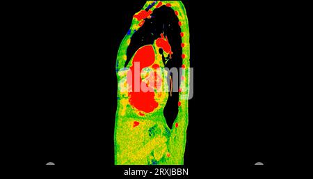 CT scan of Chest sagittal view in color mode  for diagnostic Pulmonary embolism (PE) , lung cancer and covid-19. Stock Photo