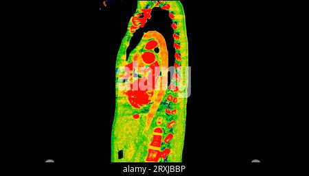 CT scan of Chest sagittal view in color mode  for diagnostic Pulmonary embolism (PE) , lung cancer and covid-19. Stock Photo