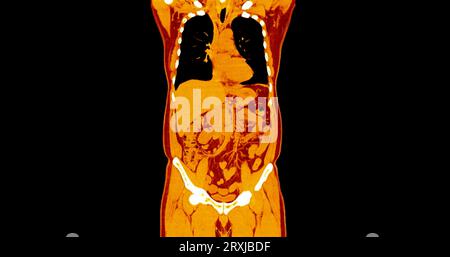 CT Chest and Abdomen with injection contrast media coronal view for diagnosis chest and  abdominal pain. Stock Photo