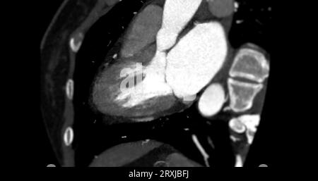 CTA Coronary artery vertival long axis view for diagnosis of vessel coronary artery stenosis. Stock Photo