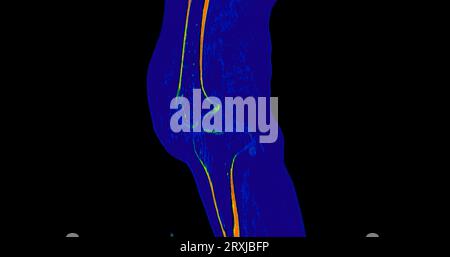 CT Scan of Knee joint sagittal and coronal in case fracture patella ...