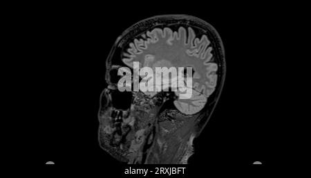MRI brain scan sagittal flair for detect Brain diseases sush as stroke ...