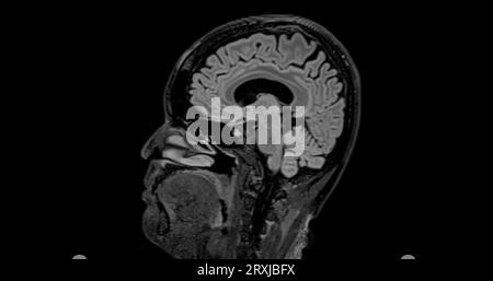 MRI brain scan sagittal flair for detect Brain diseases sush as stroke ...