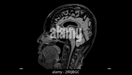 MRI brain scan sagittal flair for detect Brain diseases sush as stroke ...