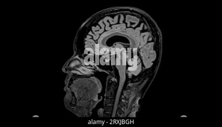 MRI brain scan sagittal flair for detect Brain diseases sush as stroke ...