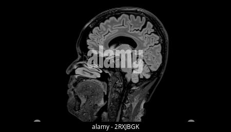 MRI brain scan sagittal flair for detect Brain diseases sush as stroke ...