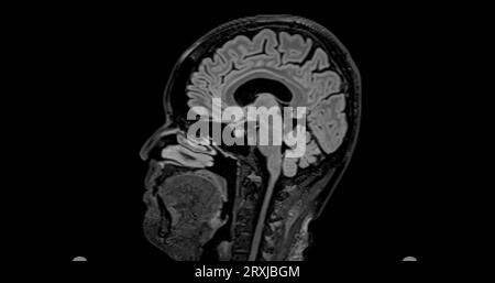 MRI brain scan sagittal flair for detect Brain diseases sush as stroke ...