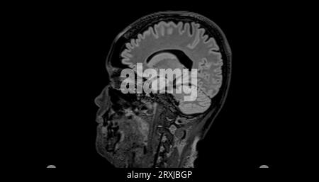 MRI brain scan sagittal flair for detect Brain diseases sush as stroke ...