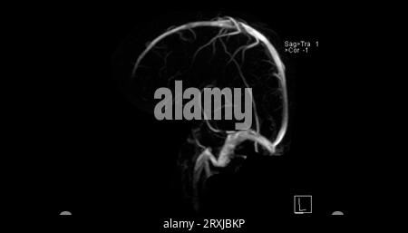 MRV Brain or magnetic resonance venography of The Brain for diagnosis abnormalities in venous drainage of the brain Stock Photo