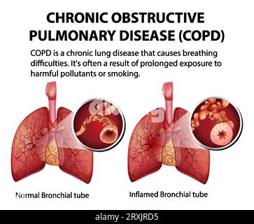 Illustrated infographic explaining chronic obstructive pulmonary ...