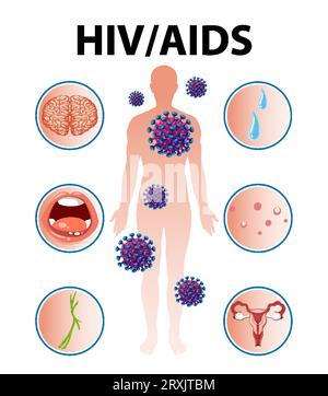 Illustration depicting the impact of HIV/AIDS on the human body Stock Vector