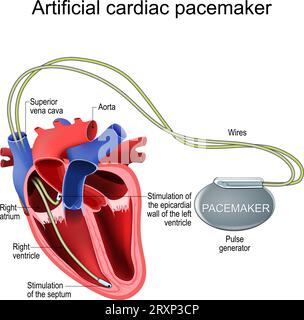 vector illustration of heart and pacemaker. cardiology Stock Vector ...