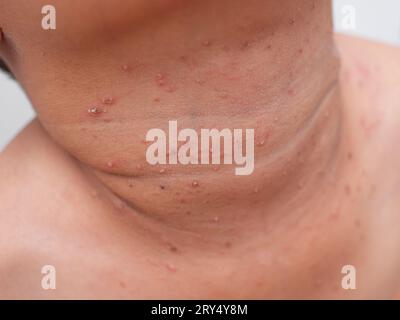 close up of child with smallpox on neck Stock Photo