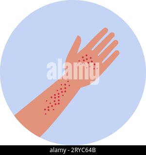 Rash on hand and arm skin, isolated medical icon Stock Vector