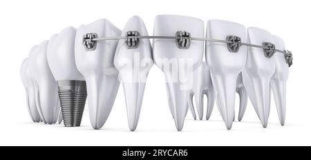 Teeth and implant Stock Photo