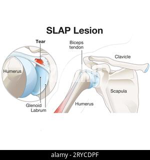 A SLAP lesion in the shoulder refers to an injury to the superior labrum, often caused by trauma or overuse, resulting in pain, instability, and reduc Stock Photo