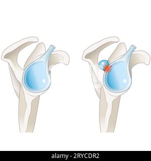 Anatomy of Shoulder , rotator cuff tear, Shoulder pain. 3d illustration ...