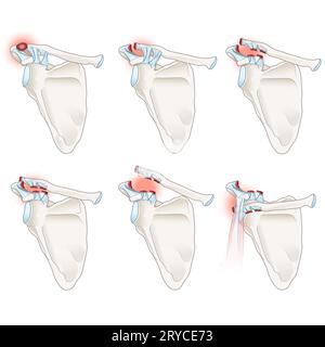 AC joint separation is a shoulder injury involving ligament damage at ...