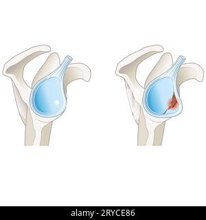 A Bony Bankart lesion in the shoulder involves a fracture of the ...