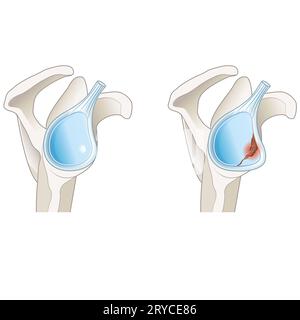 A Bony Bankart Lesion In The Shoulder Involves A Fracture Of The A Bony Bankart Lesion In The Shoulder Involves A Fracture Of The